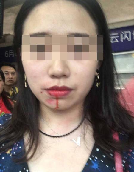 重庆轻轨一男子暴打女子致其脸肿流血图