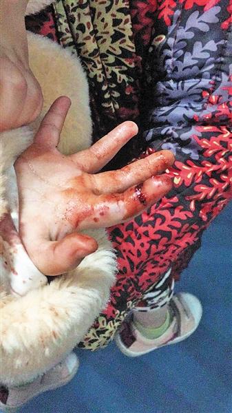 永川区恶狗咬伤多名小孩 昨日在城区被捕