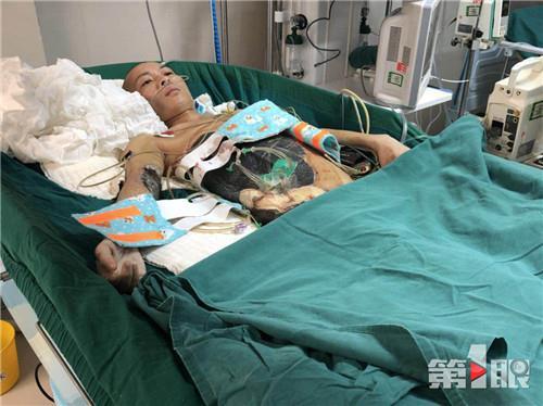 男子烧炭取暖中毒昏迷 右侧躯干几乎被"烧穿"
