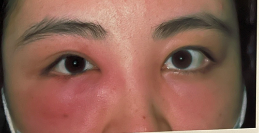 早诊断早治疗谨防慢性泪囊炎急性发作