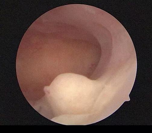 长了子宫内膜息肉则会有突起
