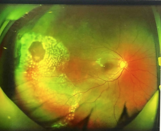 15岁少年突然视力模糊原来是视网膜脱落