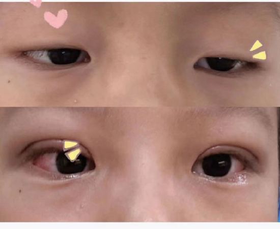术前术后对比考虑到西西双眼上睑下垂重,双眼不对称明显,有明确的手术