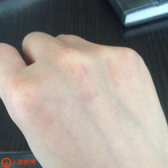 苗女士的手上有红色抓痕.