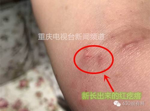 健身房储物柜竟成老鼠窝 大姐全身感染长满红疙瘩