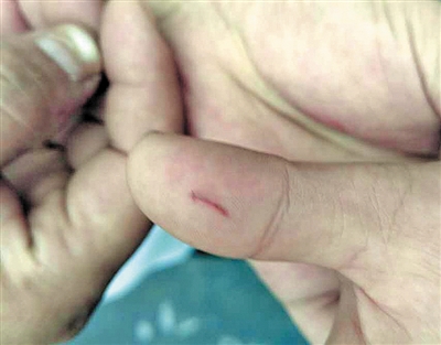 7岁小孩逗猫被抓伤重庆已发生多起猫伤人事件