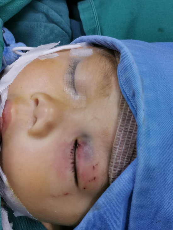 1岁宝宝被狗咬伤眼睛的求医之路:一波七折,从绝望到希望新浪重庆 2020