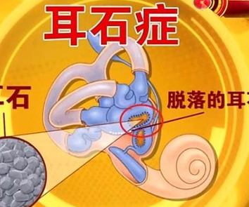 除了颈椎病高血压耳朵里的小石头也会让你经常头晕