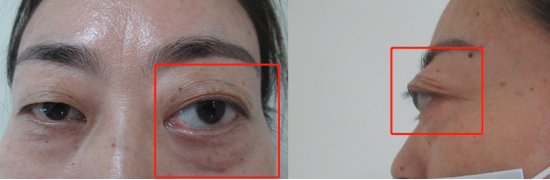 眼球突起多年摘除约3cm眼眶肿物后患者视力恢复至10