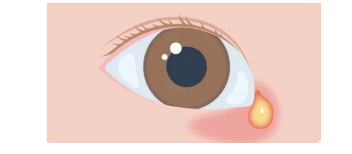 宝宝泪点低有异物眼科医生警惕泪道病