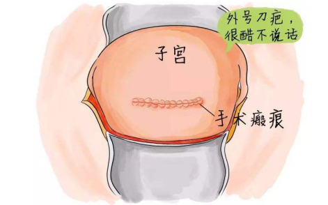 瘢痕子宫生二胎小心宝宝踢破肚子飞出来