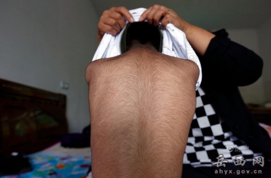 男童长满黑毛:6岁男童患怪病 体重30斤全身长满黑毛(图) 男童的身上长满了黑毛
