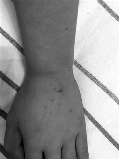 贝贝手上和腿上的伤痕