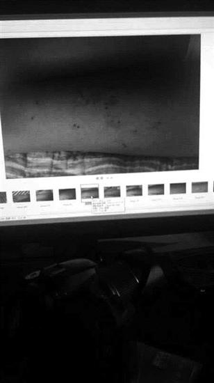 贝贝手上和腿上的伤痕