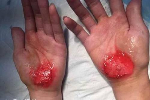 实习老师被曝罚中学生用手走路致血肉模糊图