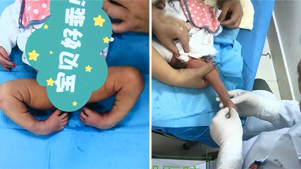 二胎宝宝刚出生 父母看了眼他的脚顿时傻眼了！