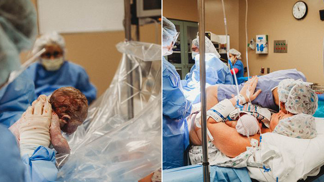 护士为自己接生 亲手把孩子从肚子里取出