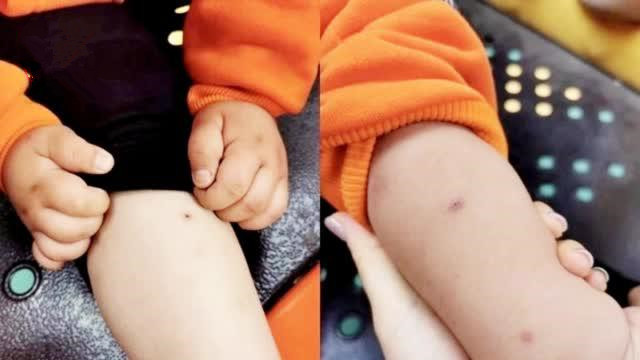腿、臀部有针孔痕迹！多名幼儿疑遭保育员针扎