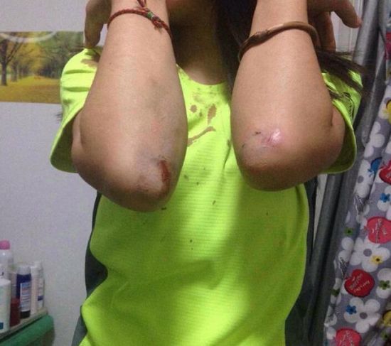 北京女跑友夜跑遭抢劫被打伤 警方已立案
