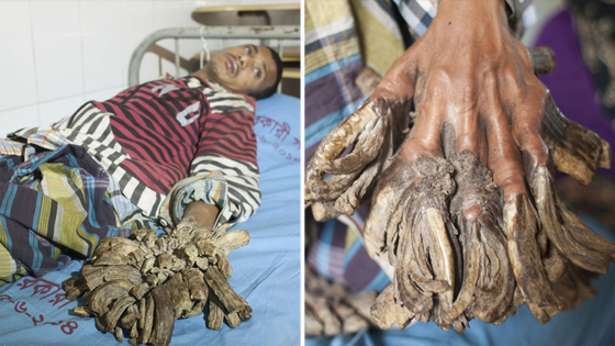 扒全球怪病.19岁女睡神走哪睡哪