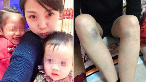 女子因未生男孩遭家暴