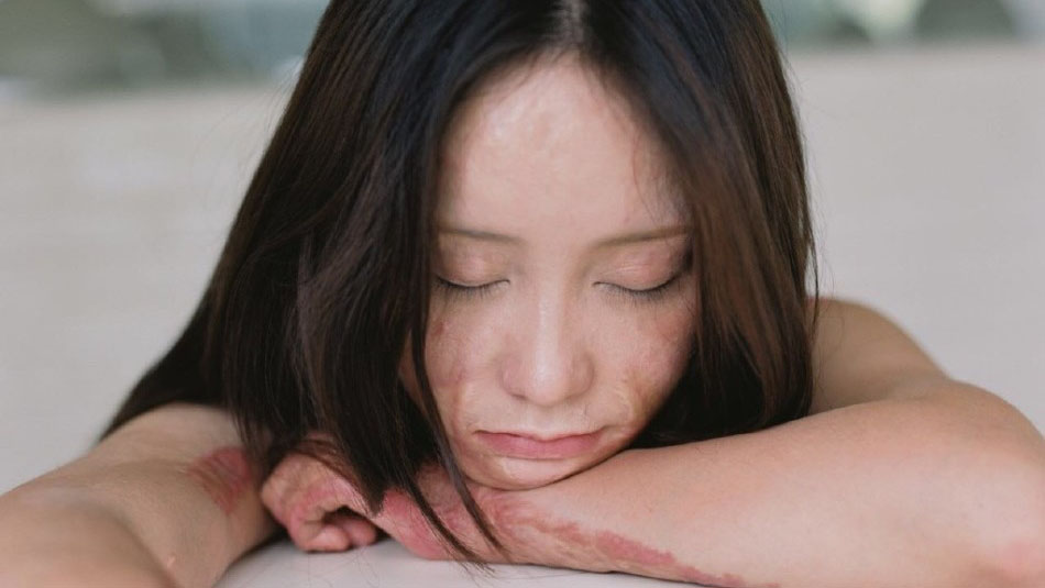 少女曾遭毁容伤痕写真曝光