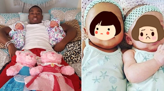 孪生姐妹肤色迥异