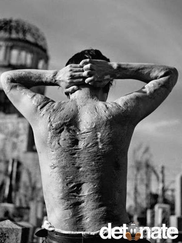 13、历史的伤疤.在广岛原子弹爆炸6年后，一位受害者展示了他的伤疤。