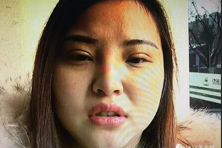 杭州一姑娘整容整成阿凡达 欲哭无泪