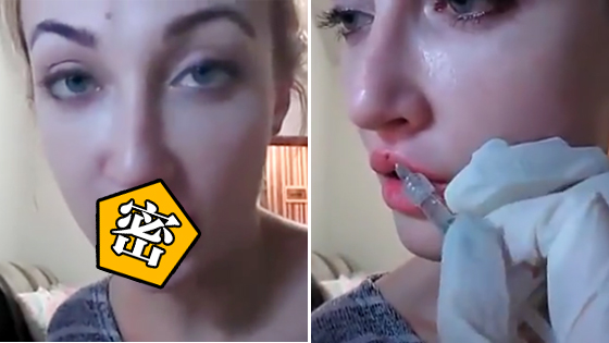 妹子自己在家打玻尿酸丰唇，十几针下去后...