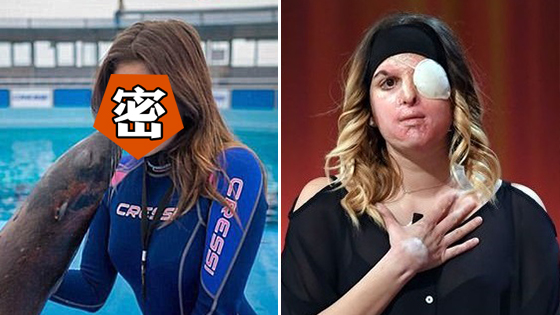 选美小姐被旧爱泼硫酸 现开启新生活