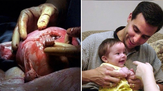 所有人都放弃时 他从子宫内伸出了小手