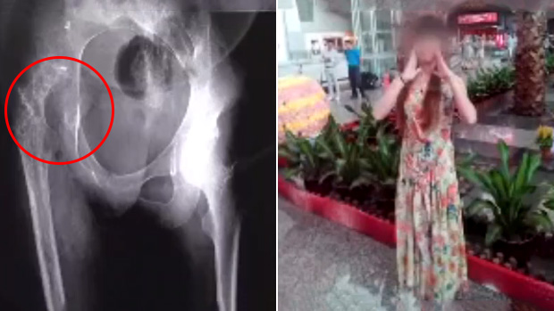 骨头被“吃掉”？少女骨头里是什么发出声响