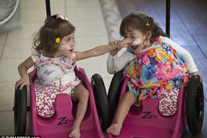 连体姐妹分离手术成功 各自只有一条腿