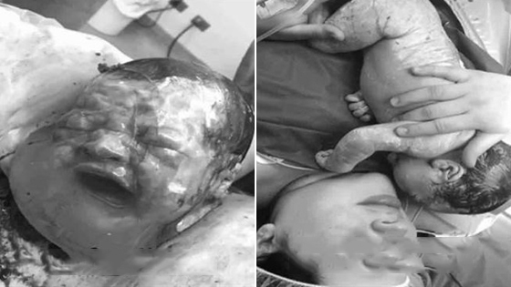 神奇的出生！实拍剖腹宝宝裹羊膜囊出世