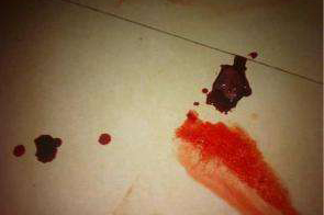 孕妇先兆流产 医生将胎儿塞回子宫