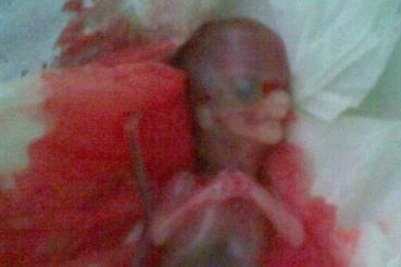 引产后胎儿遗体去哪儿？真相让人沉默！