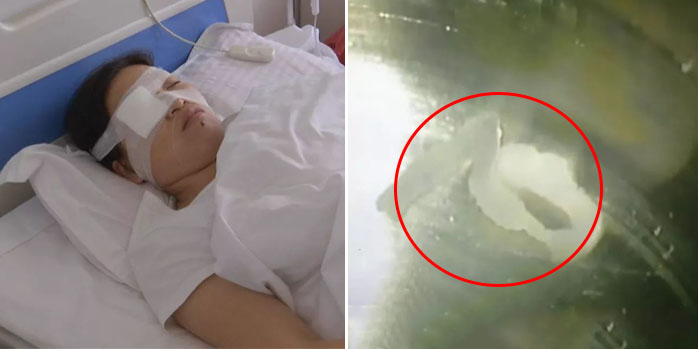 女子眼眶藏了一条5cm的虫 取出时还在蠕动