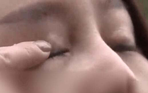 女子割双眼皮后眼睛漏光 院方却这么说>>>