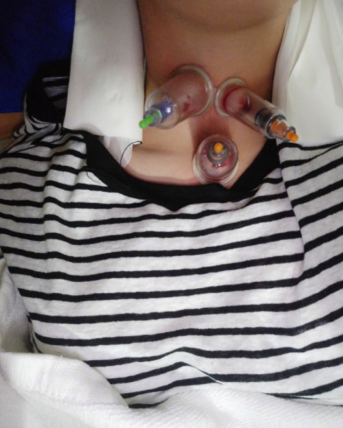 杨幂工作室晒出杨幂为治疗感冒,拔火罐针灸放血的照片,澄清多家媒体的