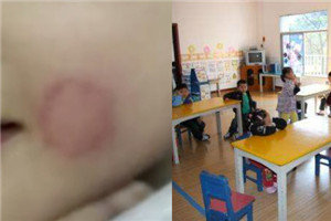 3岁男童幼儿园被咬伤 家长追责竟查出“无证办园”