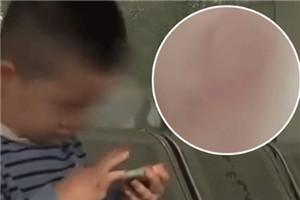 3岁幼儿胳膊多处淤青有牙印 竟是老师以牙还牙