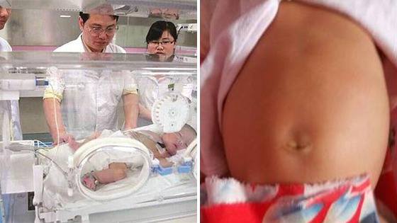 10天的宝宝做开腹手术 肚子里竟取出一双小脚！