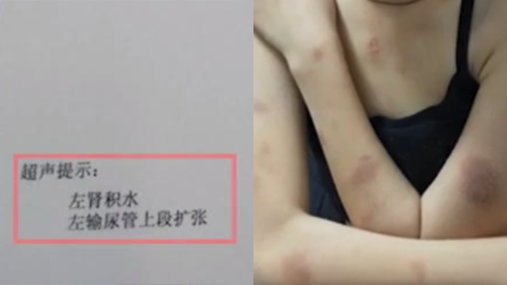 河北清河通报校园欺凌案：初一女生遭7同学多次殴打致轻伤