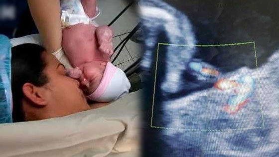 哥伦比亚降生“胎中胎”妹妹长在姐姐腹中
