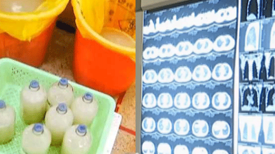 男子肺部洗出72瓶“牛奶” 这个职业可能害了他