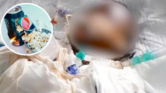 谨慎模仿！女孩用易拉罐自制爆米花 被酒精重度烧伤