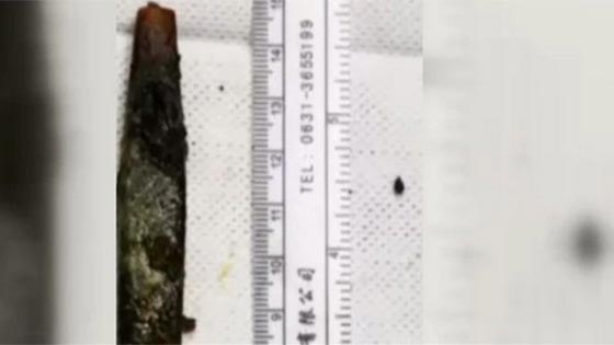 男子吞牙刷轻生20年后才取出 医生：像“出土文物”