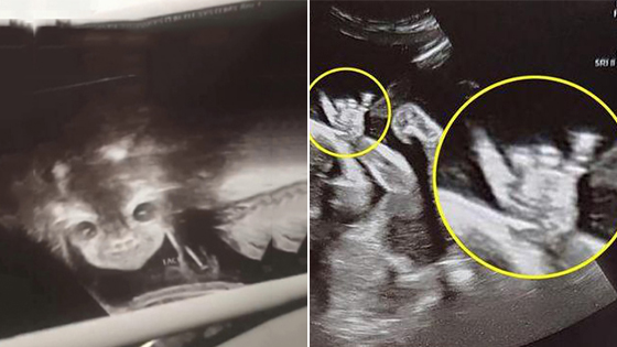 17岁孕妇做B超被吓坏 胎儿突然睁眼怪笑