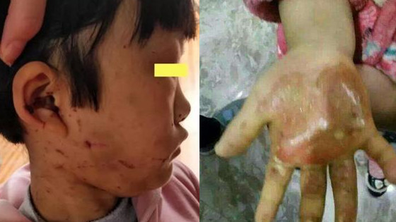 被虐女童仍昏迷,邻居曾多次听到夫妻打骂孩子